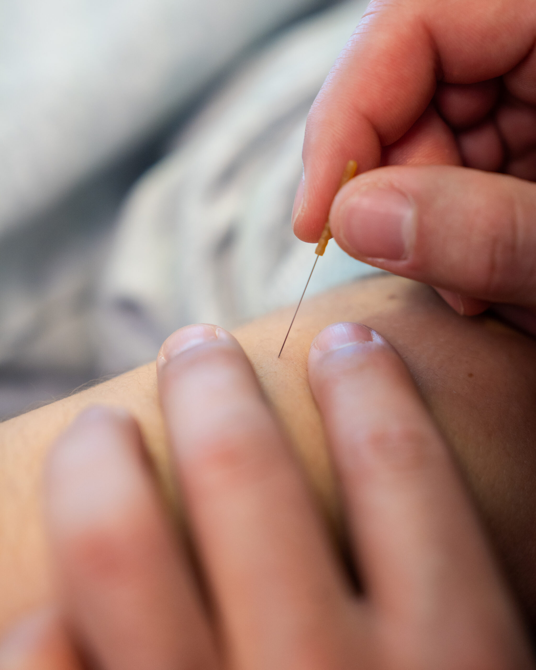 dry needling